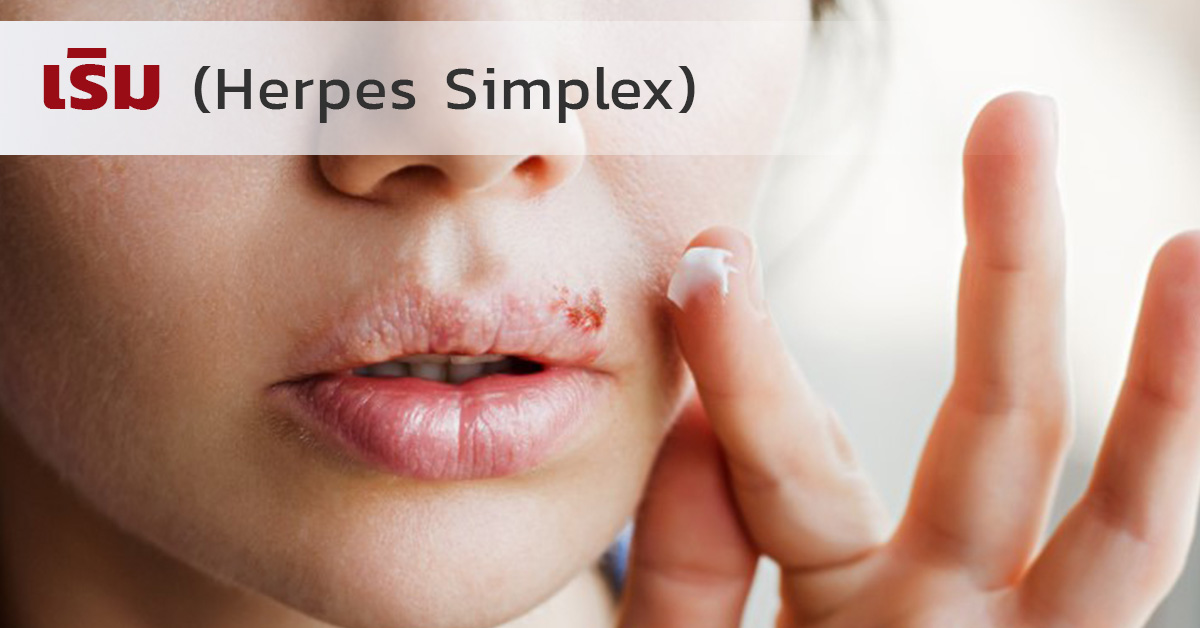 เริม (Herpes Simplex)
