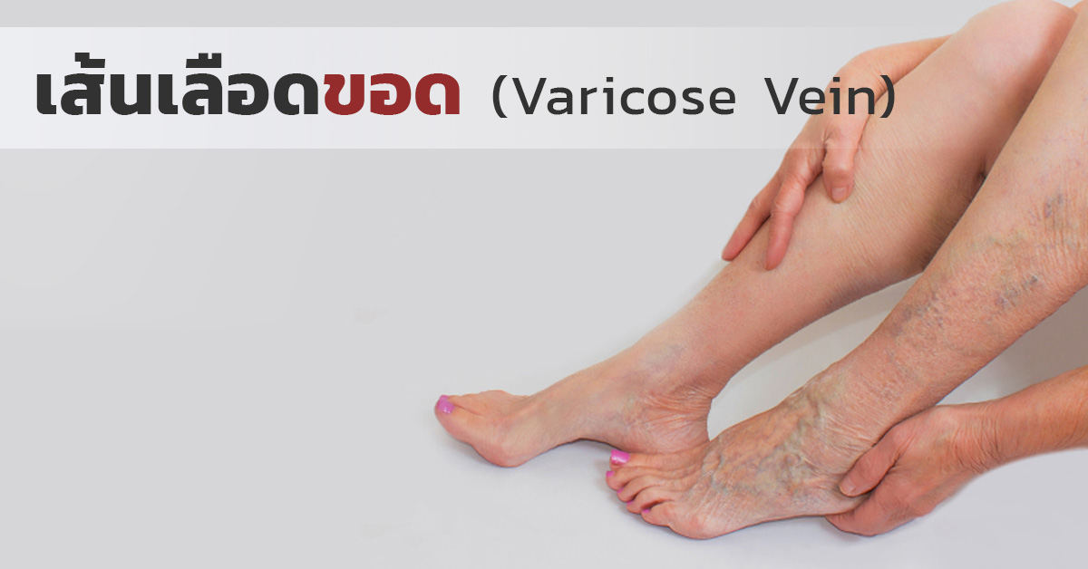 เส้นเลือดขอด (Varicose Vein)
