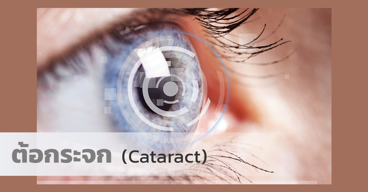 ต้อกระจก (Cataract)