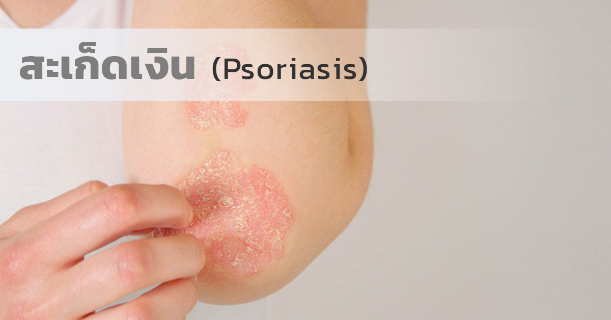 สะเก็ดเงิน (Psoriasis)