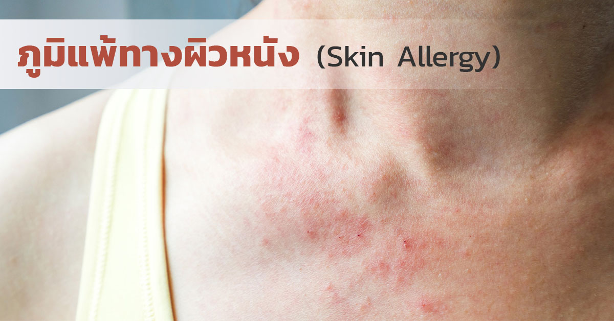 ภูมิแพ้ทางผิวหนัง (Skin Allergy)