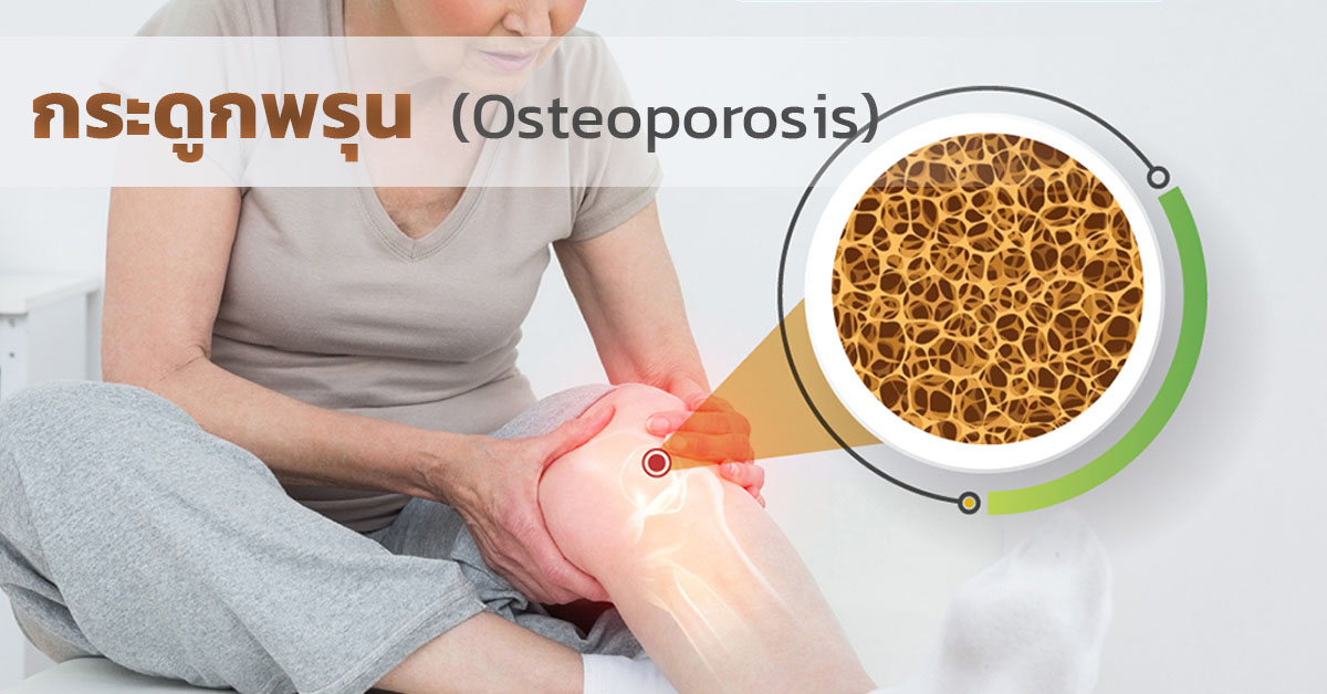กระดูกพรุน (Osteoporosis)
