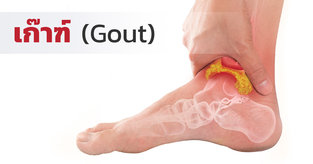 เก๊าท์ (Gout)